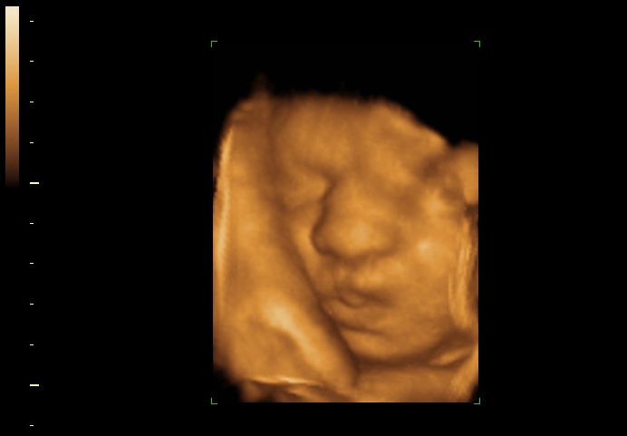 3D ultrasound image at 28 weeks